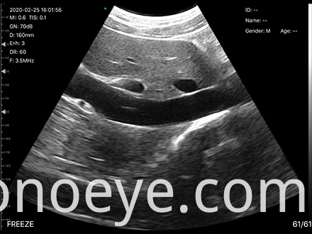 porket ultrasound